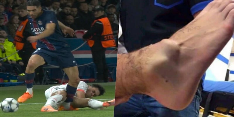 Achraf Hakimi infortunato alla caviglia sinistra nella Champions League Inter‑Milan vs Atlético Madrid