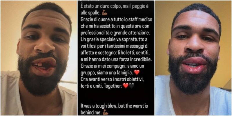 Loftus‑Cheek al Milan: intervento maxillo‑facciale dopo l’infortunio